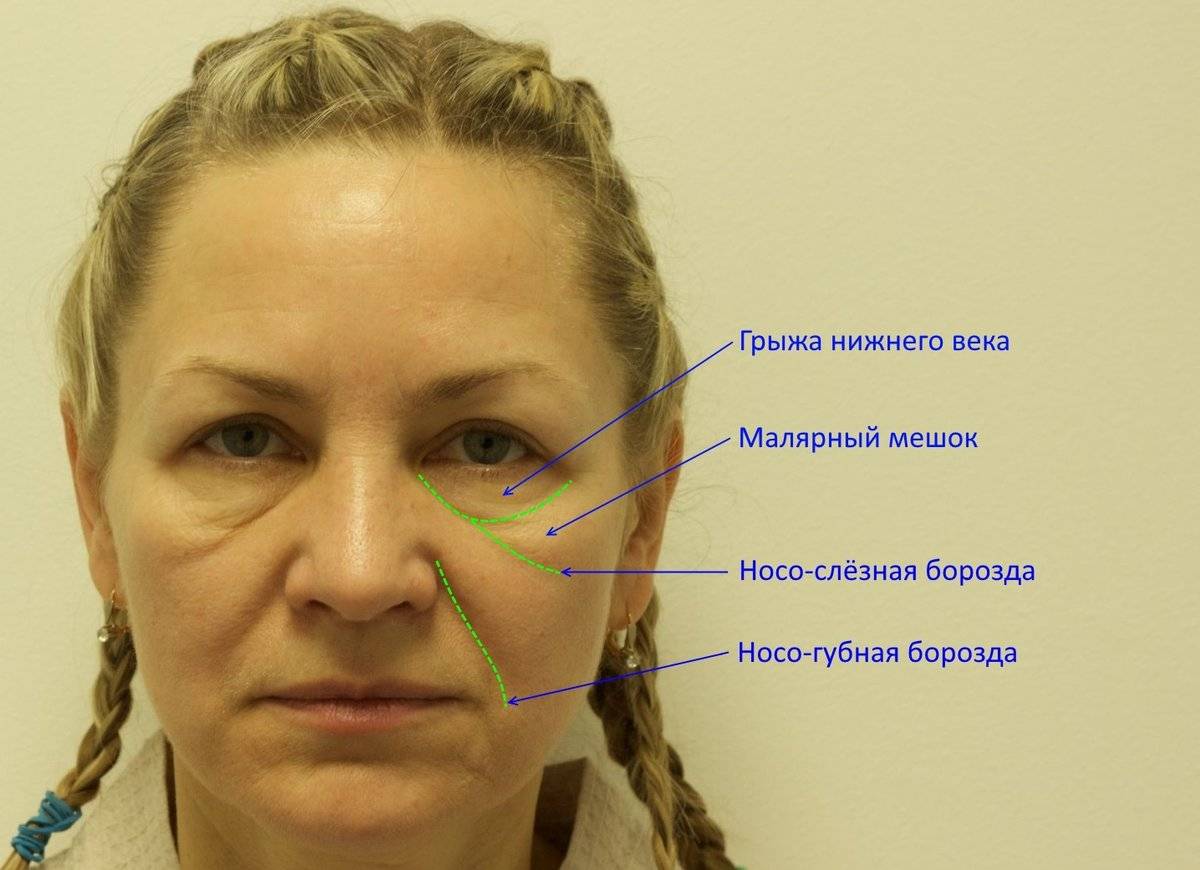 Волосы под глазами: причины и как их убрать